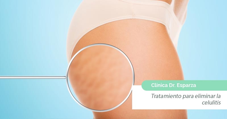 Consejos para eliminar la celulitis