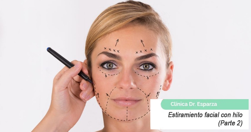 estiramiento facial en cara mujer