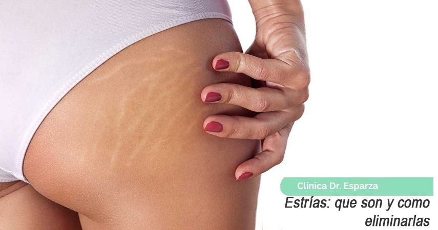 estrías