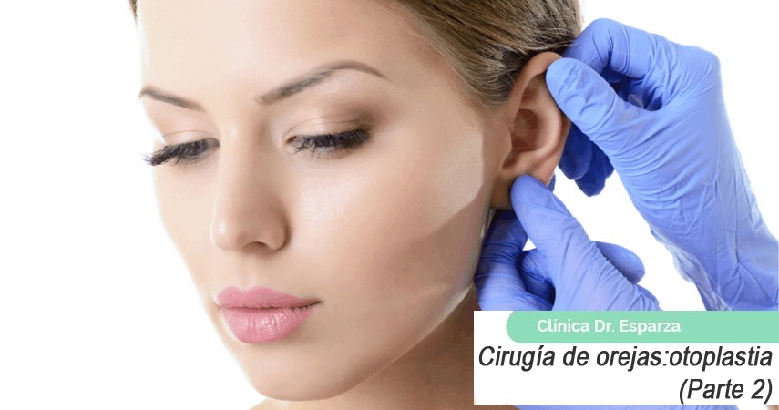 Cirugía de orejas: otoplastia (Parte 2)