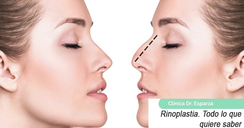 Rinoplastia. Todo lo quiere saber