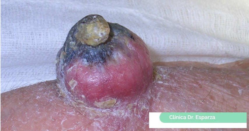 queratoacantoma Dr Esparza
