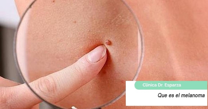 Que es el melanoma