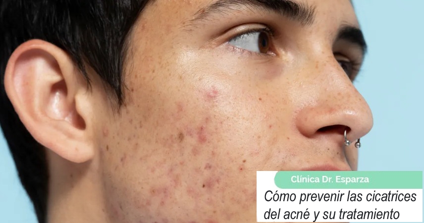 Cómo prevenir las cicatrices del acné y su tratamiento