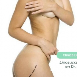 Imagen Liposucción: especialistas en Dr. Esparza Valencia