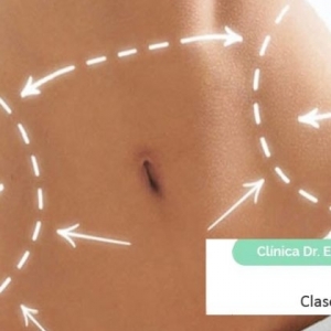 Imagen La liposucción, clases y aplicaciones