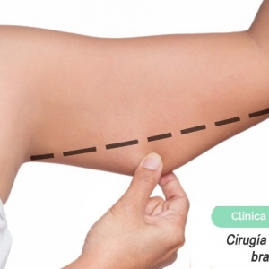 Imagen Cirugía plástica de brazos o braquioplastia (Parte 1)