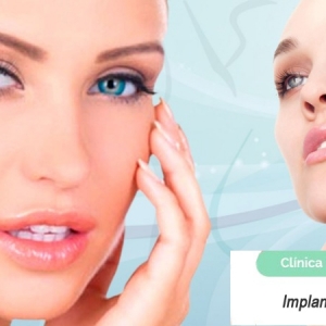 Imagen Implantes de pómulo