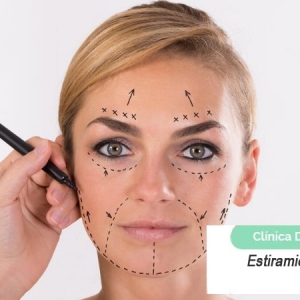 Imagen Estiramiento facial con hilo (Parte 2)