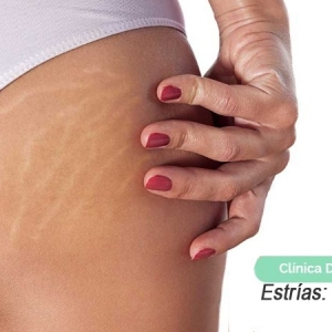 Imagen Estrías: que son y cómo eliminarlas