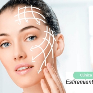 Imagen Estiramiento (lifting) con hilo (Parte 2)