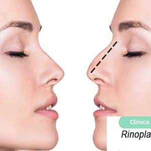 Imagen Rinoplastia. Todo lo que quiere saber
