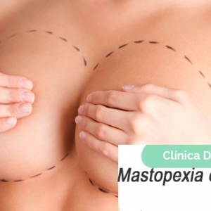 Imagen Mastopexia o levantamiento de senos