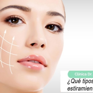 Imagen ¿Qué tipos de hilos de estiramiento facial hay?