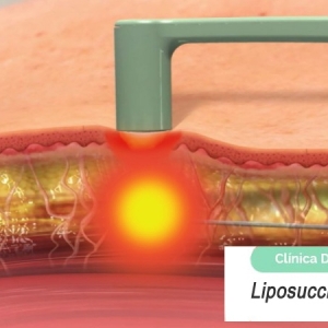 Imagen Liposucción y el Bodytite®