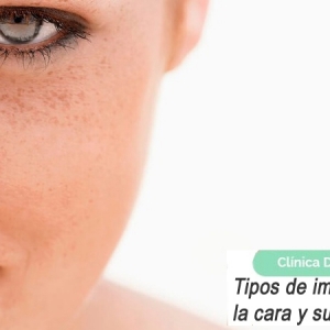 Imagen Tipos de imperfecciones en la piel de la cara y sus tratamientos