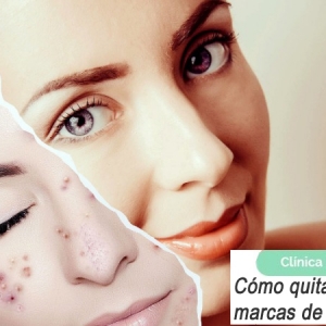Imagen Cómo quitar las manchas y marcas de la piel