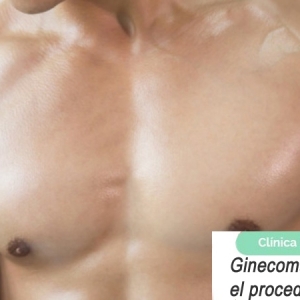 Imagen Ginecomastia masculina, el procedimiento