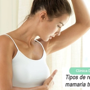 Imagen Tipos de reconstrucción mamaria tras una mastectomía