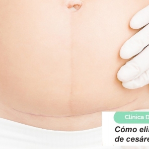 Imagen Cómo eliminar la cicatriz de cesárea