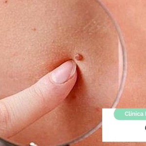 Imagen Que es el melanoma