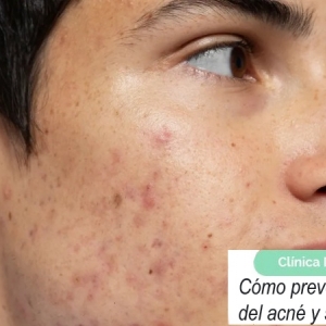 Imagen Cómo prevenir las cicatrices del acné y su tratamiento