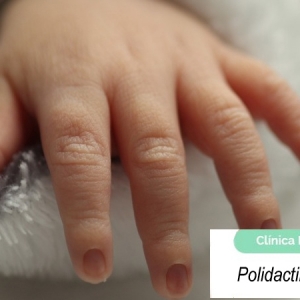 Imagen Polidactilia cubital