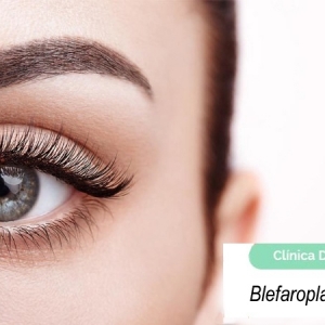 Imagen Blefaroplastia láser
